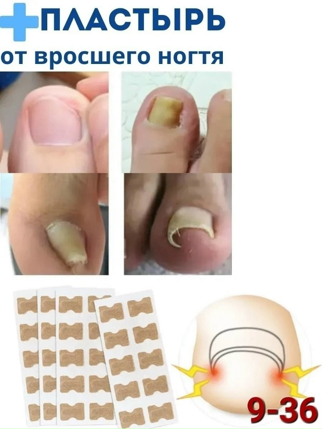 Пластырь от вросшего ногтя и грибка 23034961